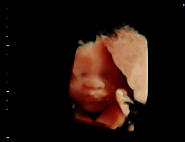 3D ultrasound image at 29 weeks